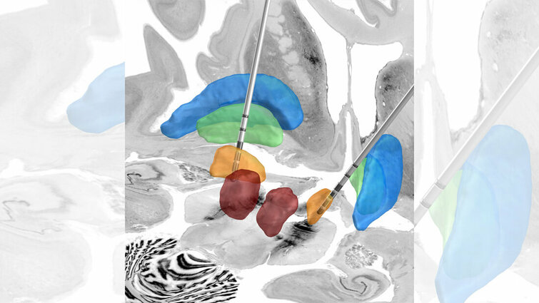 Parkinson Automatisierte Tiefe Hirnstimulation MT Dialog