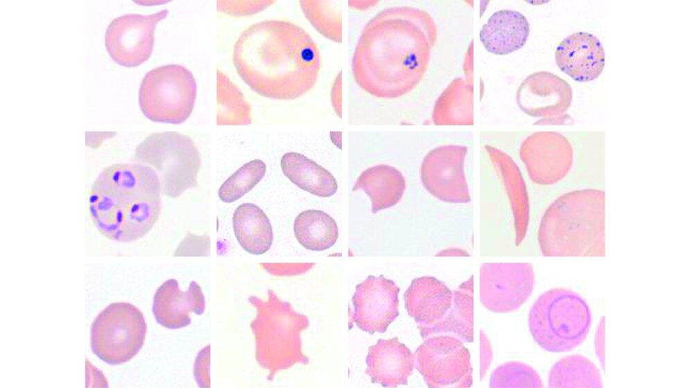 Erythrozytenmorphologie Formen und Einschlüsse