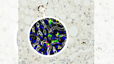 Mausleber_mit_nicht_alkoholischer_Steatohepatitis_NASH_Heikenwaelder_DKFZ.jpg Mausleber mit nicht alkoholischer Steatohepatitis