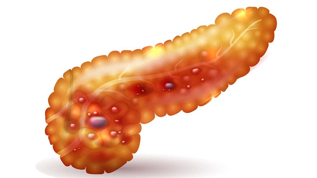 Pankreas_online.jpg Bei einem ersten Verdacht auf eine akute oder chronische Pankreatitis ist der Ultraschall durch die Bauchwand (transabdominelle Sonografie) Mittel der Wahl.