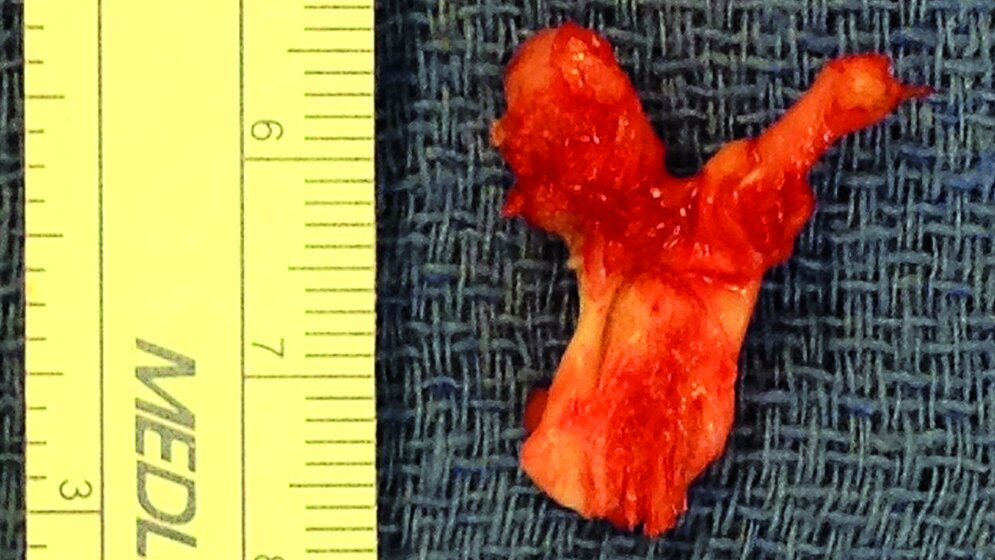 Schnittbilddiagnostik der Wirbelsäule Osteochondrom