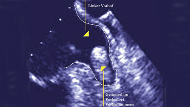 Ultraschallaufnahme_zeigt_Gerinnsel_im_linken_Vorhofohr_Aufnahme_Klinikum_Brandenburg_08042016.jpg Gerinnsel im linken Vorhofohr