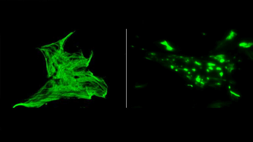 Ein_komplexes_Skelett_im_Inneren_verbindet_Zellen_fest_mit_ihren_Nachbarn_American_Journal_of_Human_Genetics_Universitaetsklinikum_Freiburg.jpg komplexes Skelett im Inneren verbindet Zellen