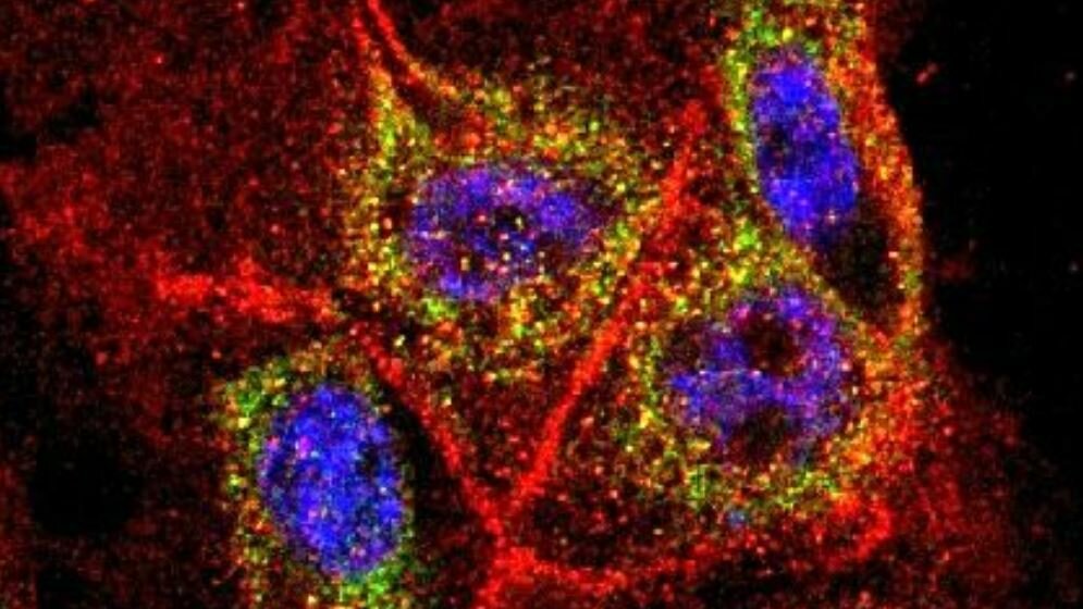 bauchspeicheldruesenkrebs_Fluoreszenzmikroskop_Rechte_Jens_Siveke_Klinikum_rechts_der_Isar_08022016.jpg Krebszellen aus der Bauchspeicheldrüse