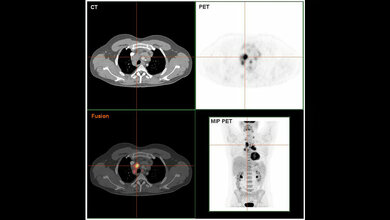 PET_CT_Aufnahme_eines_Patienten_mit_Hodgkin_Lymphom_Von_Hg6996_Eigenes_Werk_Gemeinfrei_wilkimedia.jpg PET/CT-Aufnahme