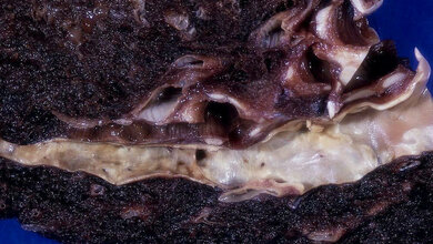 artherosklerose_Yale_Rosen_CC_BY_2_0_23082016.jpg Atherosklerose