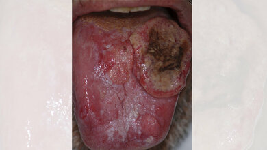 Dorsum_Zunge_Patienten_Luca_Pastore_Maria_Luisa_Fiorella_Raffaele_Fiorella_Lorenzo_Lo_Muzio_PLoS_CC_BY_2_5.jpg Dorsum der Zunge