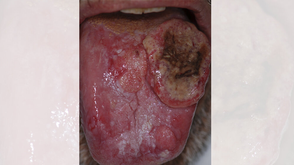 Dorsum_Zunge_Patienten_Luca_Pastore_Maria_Luisa_Fiorella_Raffaele_Fiorella_Lorenzo_Lo_Muzio_PLoS_CC_BY_2_5.jpg Dorsum der Zunge