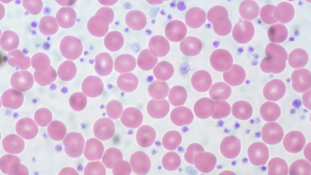 Blutausstrich_eines_Patienten_mit_myeloproliferativer_Neoplasie_Ed_Uthman_CC_BY_2.0.jpg Blutausstrich