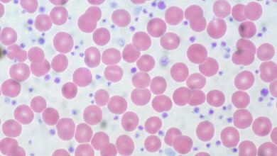 Blutausstrich_eines_Patienten_mit_myeloproliferativer_Neoplasie_Ed_Uthman_CC_BY_2.0.jpg Blutausstrich