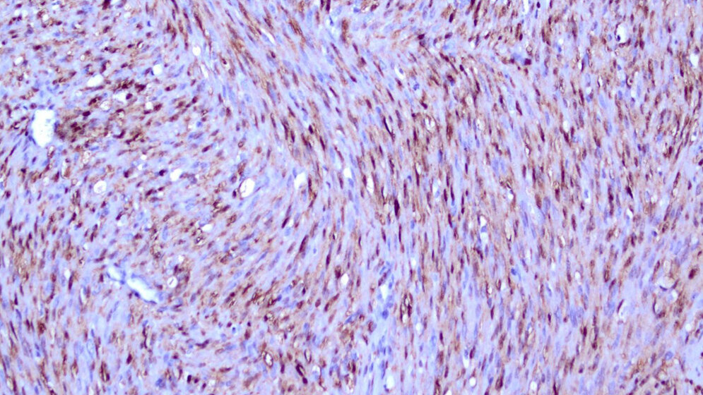 Klassisches_mesoblastisches_Nephrom_Andreas_Rosenwald.jpg Klassisches mesoblastisches Nephrom