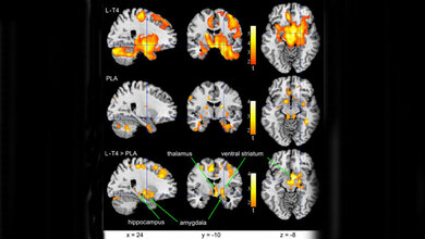 Schilddruese_doi_10.1038mp_2014_186_CC_BY_NC_ND_4_0_20062016.jpg Gehirn-Bereiche, in denen sich die relative Aktivität änderte