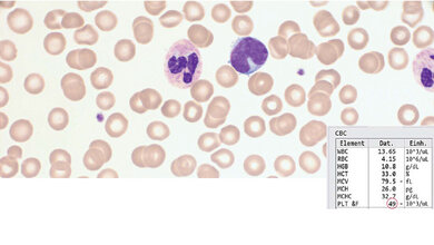 Thrombo_neu.jpg Immunthrombopenie bei einer Schwangeren