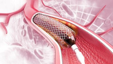 Stent.jpg Bessere Patientenselektion beim Stenting von Schlaganfallpatienten