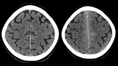 Subarachnoidale_Blutung_neben_der_Falx_Hellerhoff_eigenes_Werk_CC_BY_SA_3_0_wikimedia.jpg Subarachnoidale Blutung neben der Falx