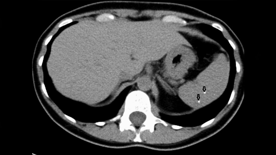 Anomalien und Normvarianten –
Interne Veränderungen 2.24: Phlebolithen CT des Abdomen mit Phlebolithen der Milz