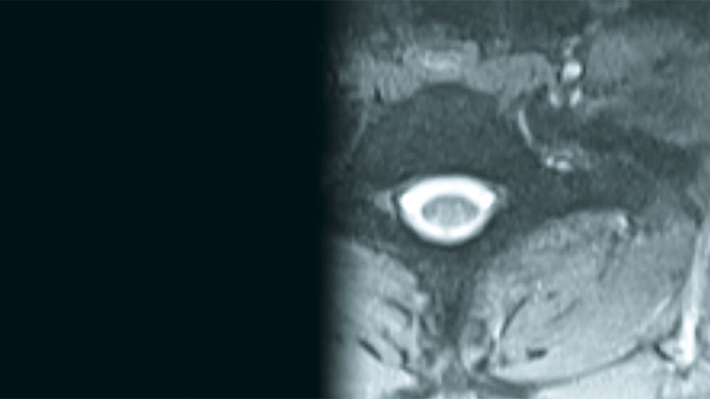 Bildgebende Verfahren Spinale Malformationen: Stummelrippen und Querfortsatzanomalie der Halswirbelsäule