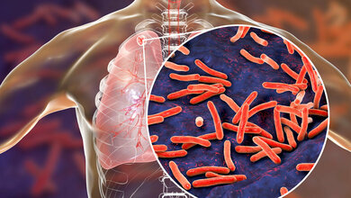 Tuberkulose_bekaempfen.jpg Tuberkulose