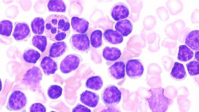 In_Leukaemiezellen_lila_wird_Signalweg_zum_natuerlichen_Absterben_wieder_freigemacht_Foto_Universitaetsklinikum_Ulm_20052016.jpg Leukämiezellen