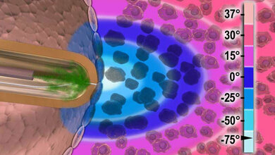 Temperaturverteilung_bei_Kryoablation_CryoCath_Technologies_Inc_CC_BY_SA_3_0.jpg Kryoablation