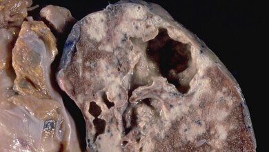 Tuberkulose_yale_rosen_CC_BY_SA_2_23032016.jpg Tuberkulose