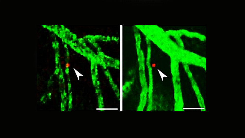 einzelne_Lymphomzellen_Heikenwaelder_DKFZ.jpg einzelne Lymphomzellen