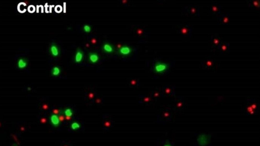 Alpha_Synuklein_Ansammlungen_gruen_toxisch_fuehren_zum_Zelltod_rot_Prof_Outeiro_CNMPB_18032016.jpg α-Synuklein-Ansammlungen