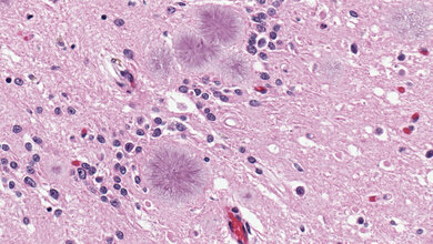 Amyloide_Plaques_in_einem_Fall_der_Variante_Creutzfeldt_Jakob_Krankheit_vCJD_CDC_Sherif_Zaki_MD_PhD_Wun_Ju_Shieh_MD_PhD_MPH.jpg Variante Creutzfeldt-Jakob Krankheit