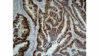 IHC_Teil_eines_Resektats_eines_Darmkrebspatienten_umg_mol_onko.jpg Immunhistochemische Färbung des „bösen Bruders“