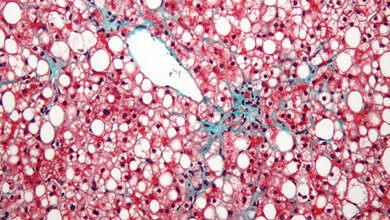 Non-alcoholic_fatty_liver_disease_By_Nephron_CC_BY_SA_3_0_01072016.jpg Nicht-alkoholische Fettleber