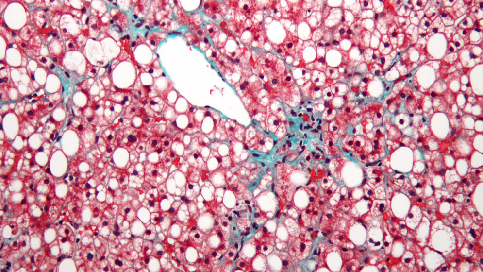 Non-alcoholic_fatty_liver_disease_By_Nephron_CC_BY_SA_3_0_01072016.jpg Nicht-alkoholische Fettleber