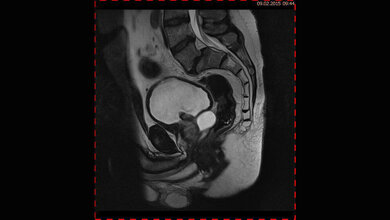 Schnittbilddiagnostik der Wirbelsäule Zufallsbefunde: Samenblasenzyste