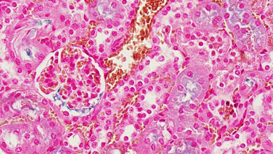 Eisen_frei_blau_Eisen_Protein_Komplex_braun_CSB_Massachusetts_General_Hospital_22072016.jpg Giftiges Eisen in Organen