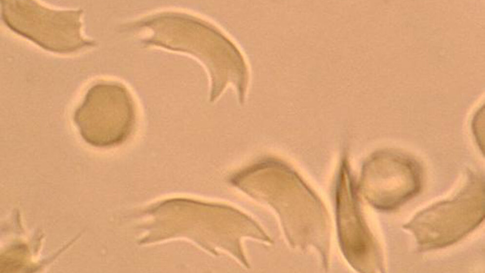 Sichelzellen_nach_O2_Entzug_mittels_Sichelzelltest_BB_Nativpraeparat_UK_Aachen.jpg Sichelzellen nach O2-Entzug mittels Sichelzelltest