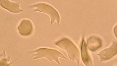 Sichelzellen_nach_O2_Entzug_mittels_Sichelzelltest_BB_Nativpraeparat_UK_Aachen.jpg Sichelzellen nach O2-Entzug mittels Sichelzelltest