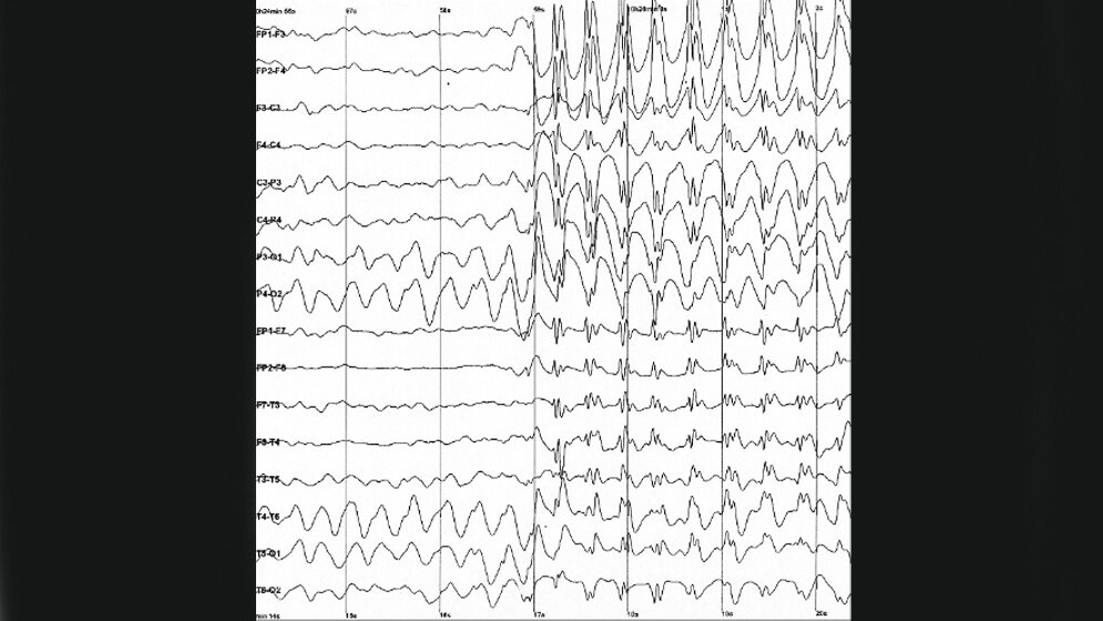 Fuer_eine_Absence_Epilepsie_typisches_Anfallsmuster_im_EEG_CC_BY_SA_2_0.jpg Für eine AbsenceEpilepsie typisches Anfallsmuster