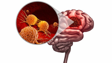 Gehirntumor.jpg Neue Studie zur Bekämpfung des Glioblastoms