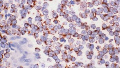 Small_cell_lung_cancer_yale_Rosen_CC_BY_SA_2_Ausschnitt_23032016.jpg Kleinzelliger Lungenkrebs