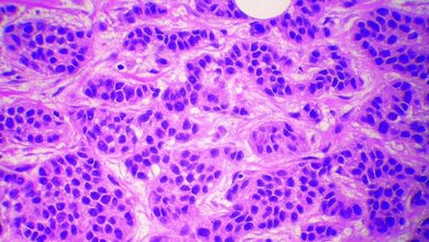 MTA_Dialog_05_2016_Titelbild_Boesl_Mammakarzinome.jpg Metastasiertes Mammakarzinom