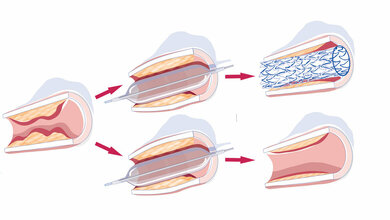 Stent_Copyright_Deutsche_Gesellschaft_für_Angiologie.jpg Stent