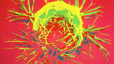 Brustkrebszelle_von_Unbekannter_Fotograf_Public_domain_via_Wikimedia_Commons.jpg Brustkrebszelle