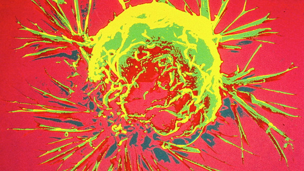 Brustkrebszelle_von_Unbekannter_Fotograf_Public_domain_via_Wikimedia_Commons.jpg Brustkrebszelle