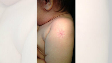 Narbe_durch_einen_BCG_Impfstoff_Gzzz_CC_BY_SA_4_0.jpg Narbe durch BCG-Impfstoff