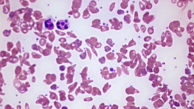 Blutausstrich_bei_Sichelzellanaemie_Rick_Jan_Kluitenberg_eigenes_Werk_CC_BY_SA_3_0.jpg Blutausstrich bei Sichelzellenanämie