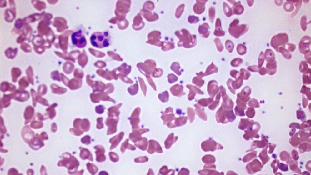 Blutausstrich_bei_Sichelzellanaemie_Rick_Jan_Kluitenberg_eigenes_Werk_CC_BY_SA_3_0.jpg Blutausstrich bei Sichelzellenanämie