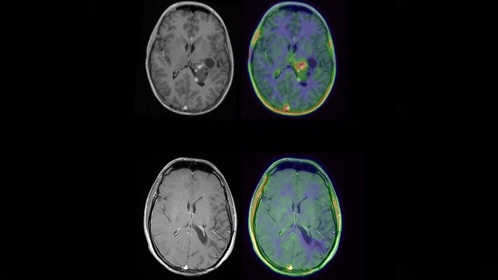 MRT_eines_Patienten_mit_Glioblastom_UKR.jpg MRT eines Patienten mit Glioblastom