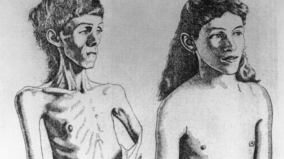 Clinical_Conditions_Anorexia_Nervosa_Credit_Wellcome_Collection_CC_BY.jpg Anorexia Nervosa.