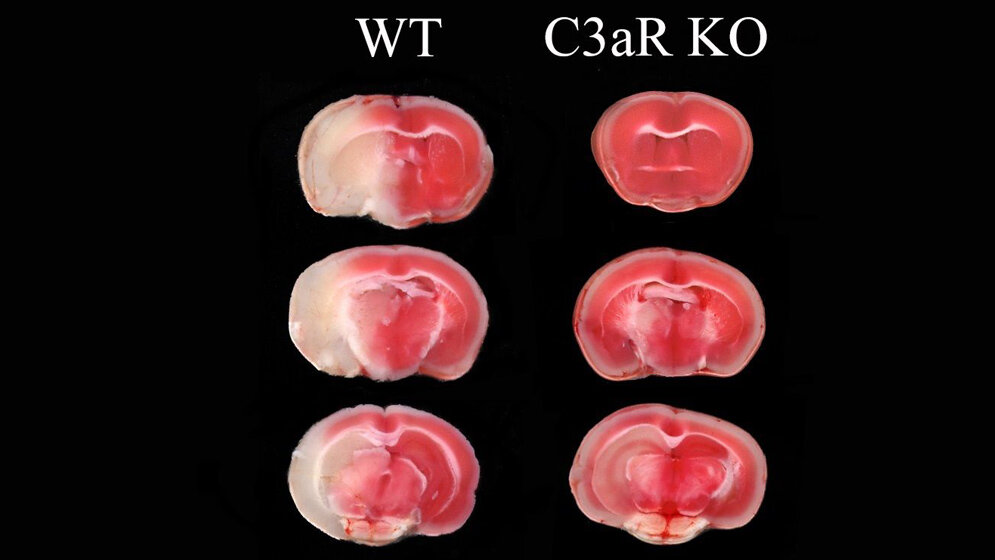 nach_einem_Schlaganfall_ist_das_geschädigte_Hirnareal_weiß_relativ_gross_UDE_UK_Essen.jpg nach einem Schlaganfall ist das geschädigte Hirnareal (weiß) relativ groß