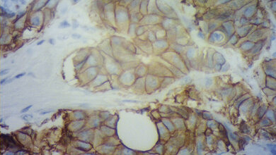 Immunhistochemie Routinediagnostik in der Pathologie, Differenzialdiagnostik bei Tumorerkrankungen