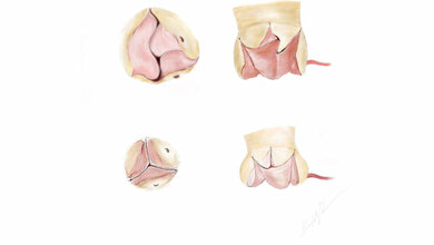 Illustration_der_Ozaki_Klappe_Quelle_Ly_Ho_Nghiem_UKSH.jpg Illustration der Ozaki-Klappe